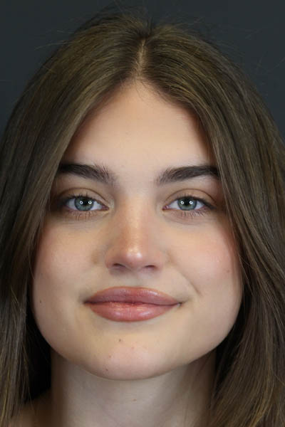 Rhinoplasty case #8366