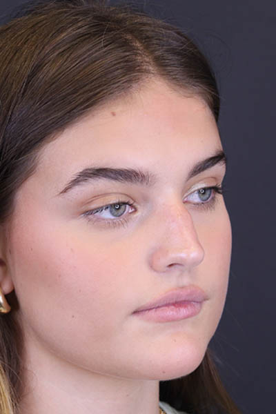 Rhinoplasty case #8366