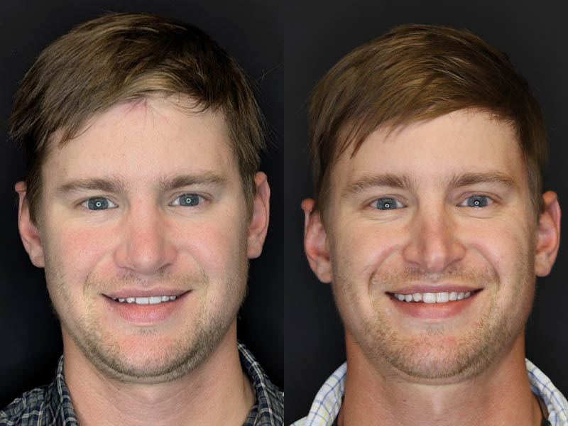 Revision Rhinoplasty case #8443