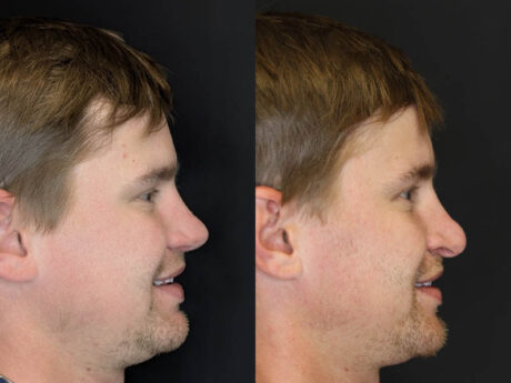 Revision Rhinoplasty case #8443