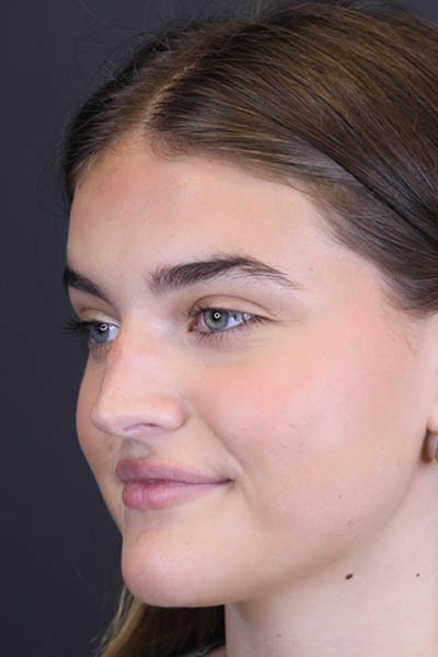 Rhinoplasty case #8366