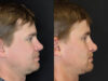 Revision Rhinoplasty case #8443 slider thumbnail