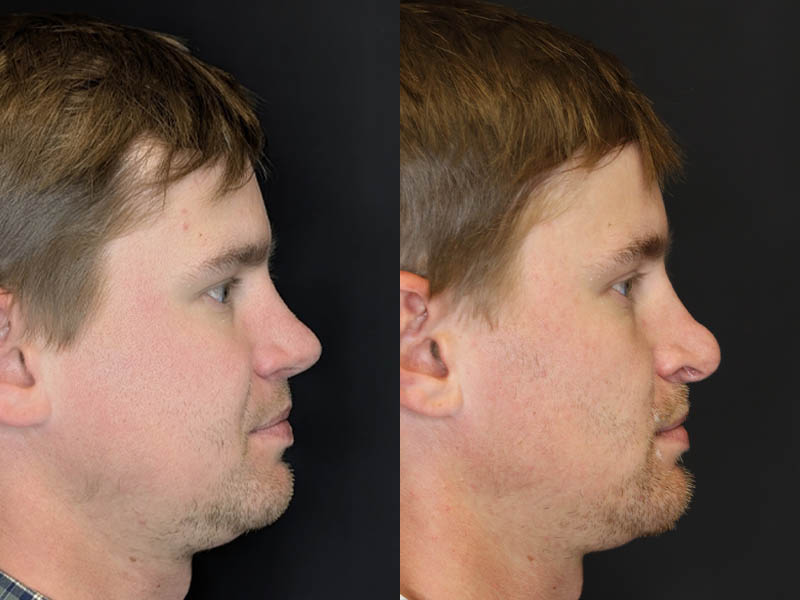 Revision Rhinoplasty case #8443