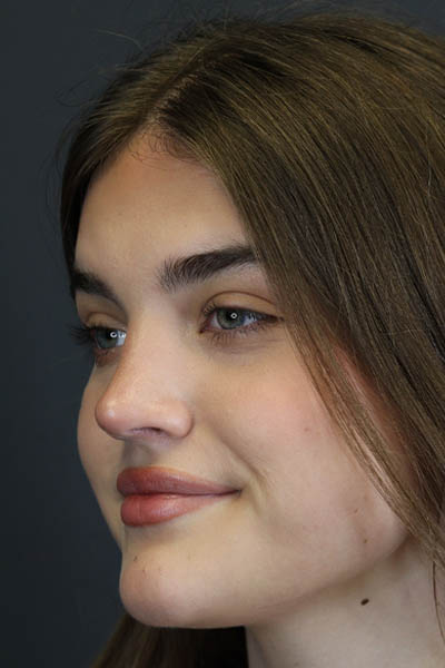 Rhinoplasty case #8366