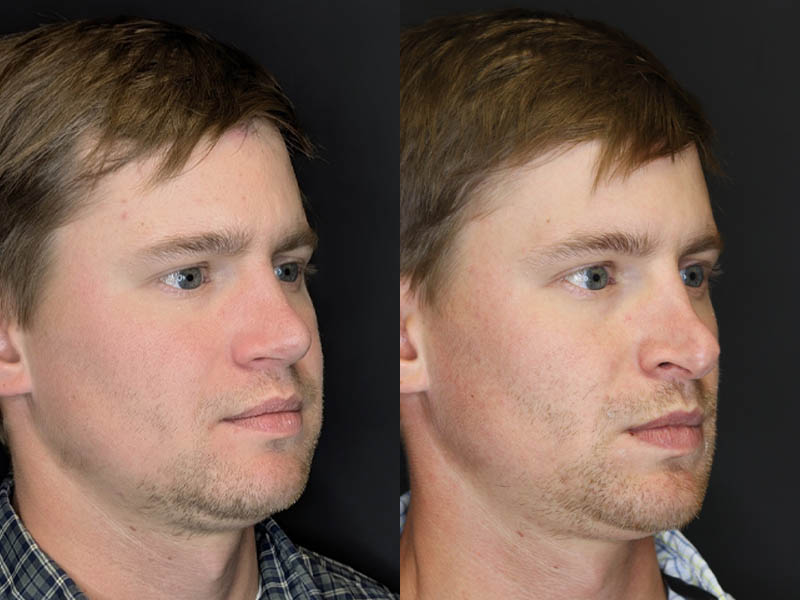 Revision Rhinoplasty case #8443