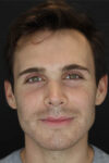 Rhinoplasty case #8381
