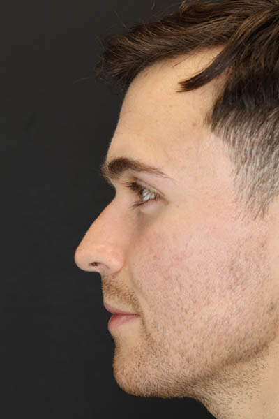 Rhinoplasty case #8381