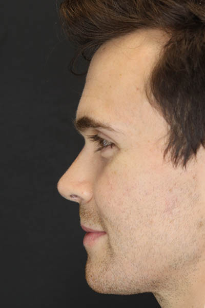 Rhinoplasty case #8381