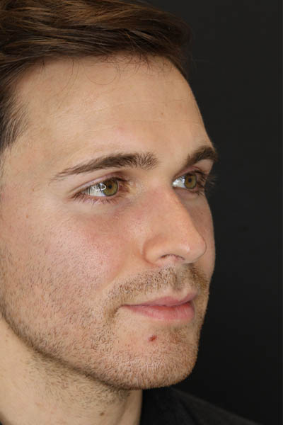 Rhinoplasty case #8381