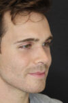 Rhinoplasty case #8381