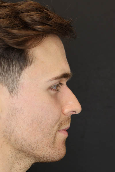 Rhinoplasty case #8381