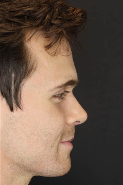 Rhinoplasty case #8381