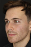 Rhinoplasty case #8381