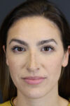 Rhinoplasty case #8392
