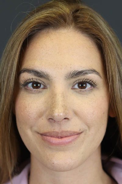 Rhinoplasty case #8392