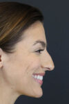 Rhinoplasty case #8392