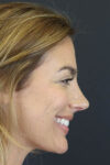 Rhinoplasty case #8392