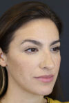Rhinoplasty case #8392