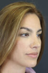 Rhinoplasty case #8392