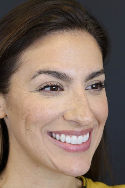 Rhinoplasty case #8392