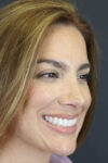 Rhinoplasty case #8392