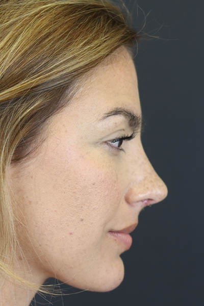 Rhinoplasty case #8392