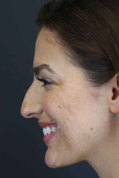 Rhinoplasty case #8392