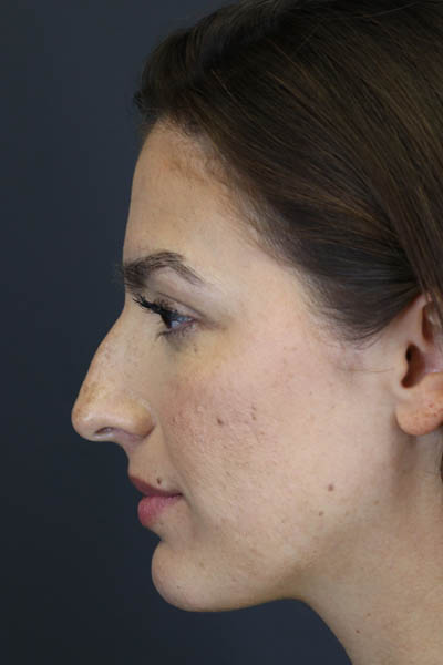 Rhinoplasty case #8392