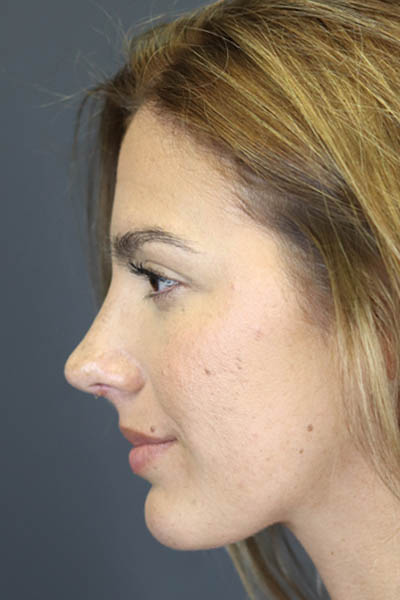 Rhinoplasty case #8392