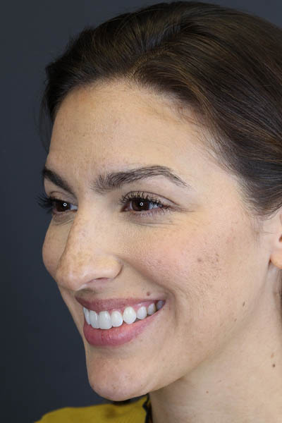 Rhinoplasty case #8392