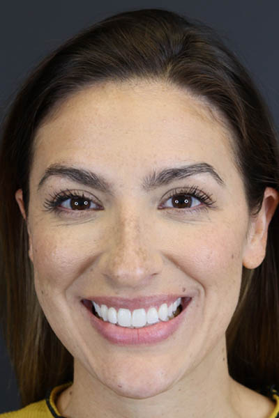 Rhinoplasty case #8392