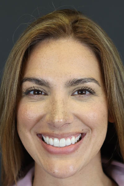 Rhinoplasty case #8392