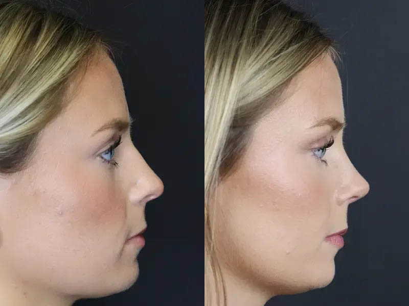 Rhinoplasty case #8344