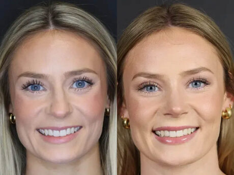 Rhinoplasty case #8344