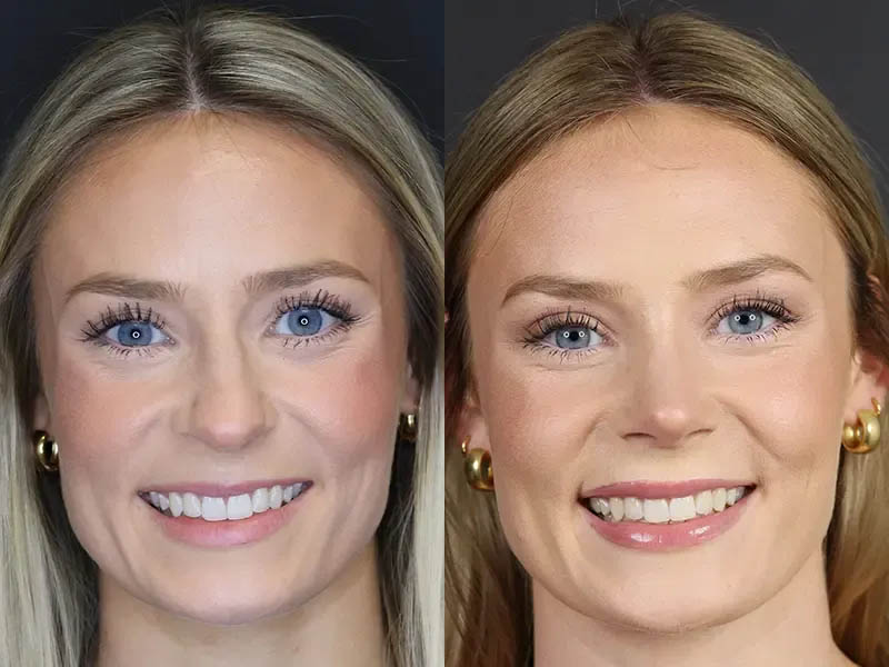 Rhinoplasty case #8344