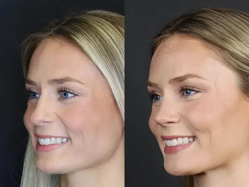 Rhinoplasty case #8344