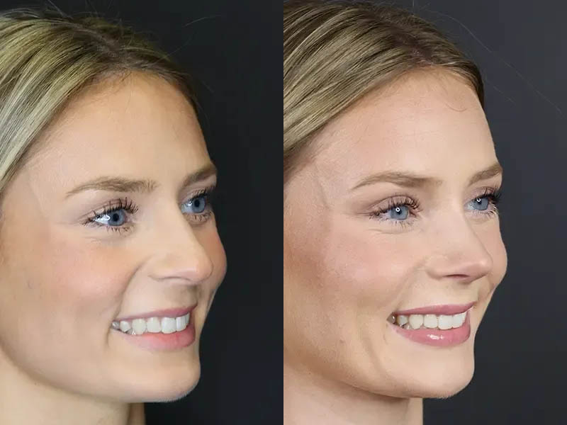 Rhinoplasty case #8344