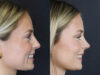 Rhinoplasty case #8344 slider thumbnail