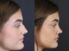 Rhinoplasty case #8366 slider thumbnail