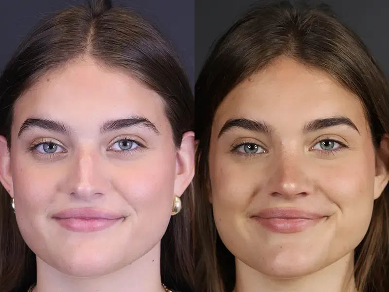 Rhinoplasty case #8366