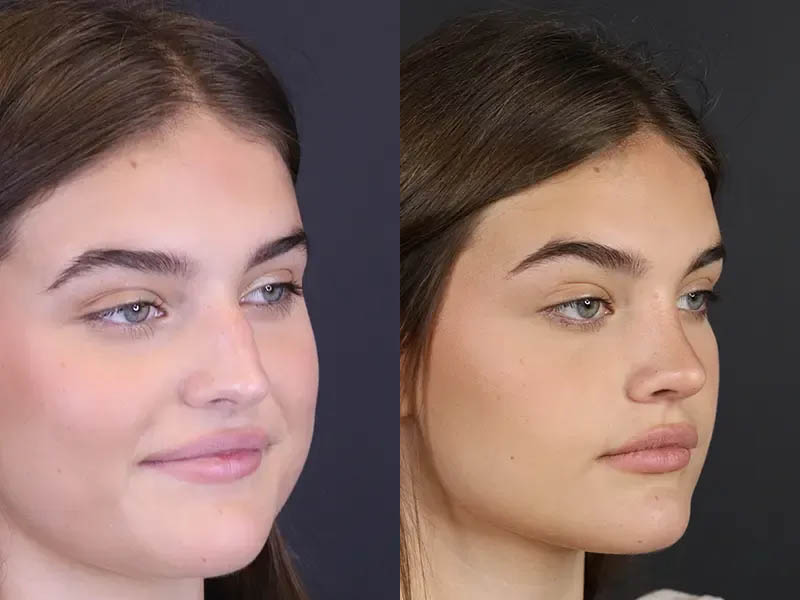 Rhinoplasty case #8366