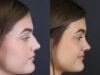 Rhinoplasty case #8366 slider thumbnail