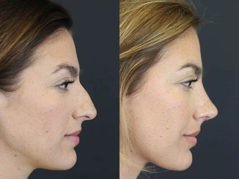 Rhinoplasty case #8392