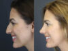 Rhinoplasty case #8392 slider thumbnail
