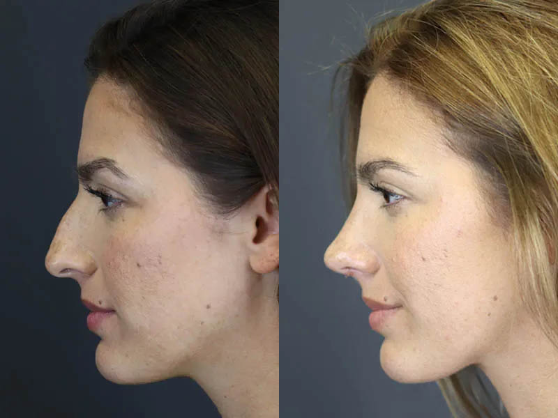 Rhinoplasty case #8392