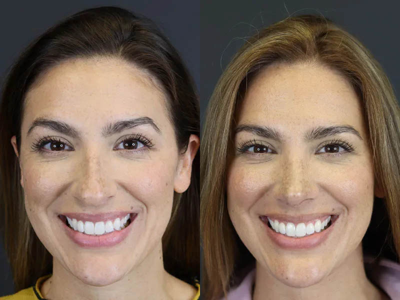 Rhinoplasty case #8392