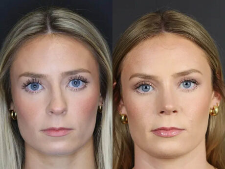 Rhinoplasty case #8344