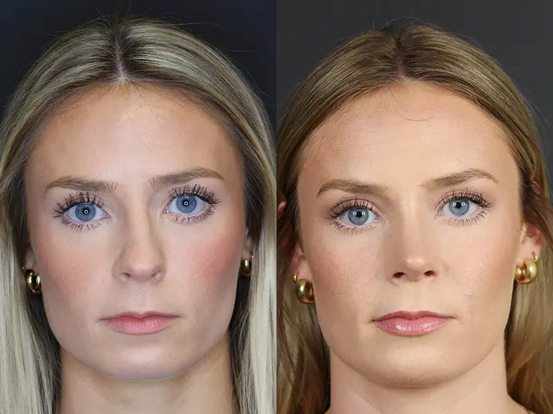 Rhinoplasty case #8344