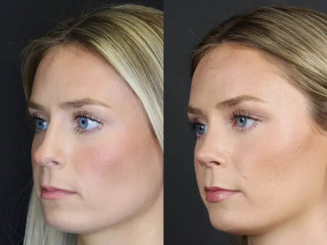 Rhinoplasty case #8344