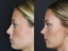Rhinoplasty case #8344 slider thumbnail